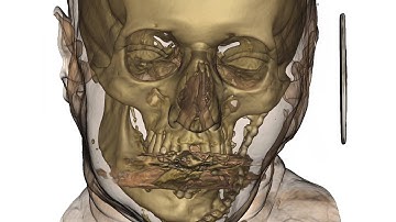 3Diagnosys & PlastyCAD September 2015 New Features!