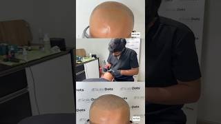 Scalp Micropigmentation: Benefits, Side Effects, Before &amp; After Pics !by Dr Varun Nambiar