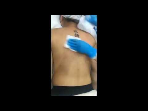 Chemical Peel & Back Acne Extraction Facebook Live | Canada MedLaser Clinics