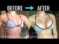 MY BREAST AUGMENTATION EXPERIENCE – Process, Recovery & Details!