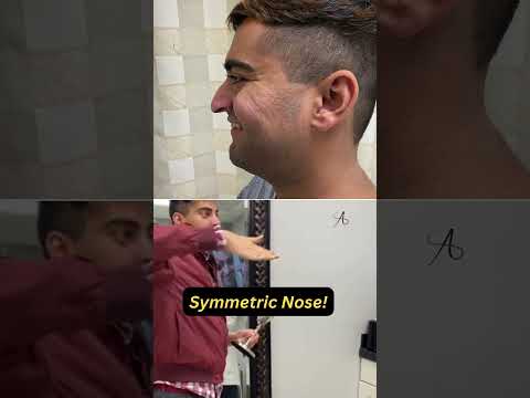 Video thumbnail: My Nose Looks Great!| Correction of Asymmetric & Droopy Nose! · Ali Sajjadian