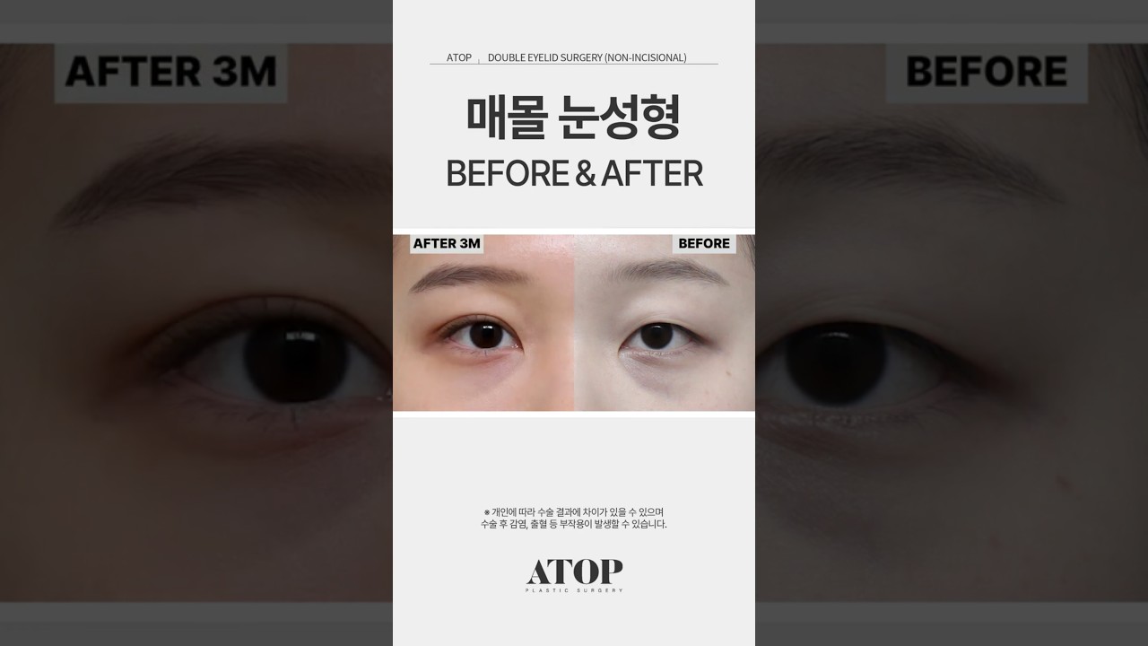 [艾塔普整形外科] 埋線雙眼皮 真實術前術後