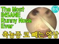 축농증 코 빼는 영상