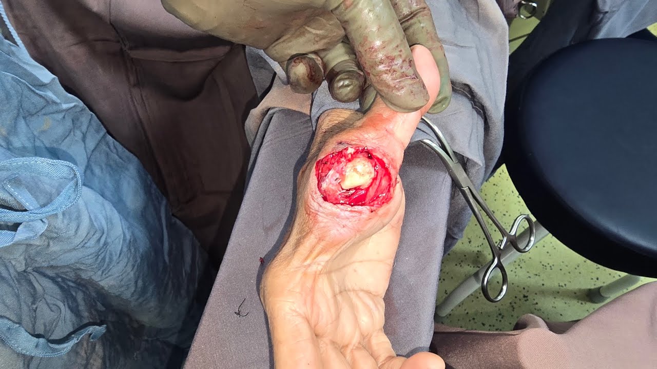 Thumb Dislocation, Bone Sticking Out, Ligaments Torn!