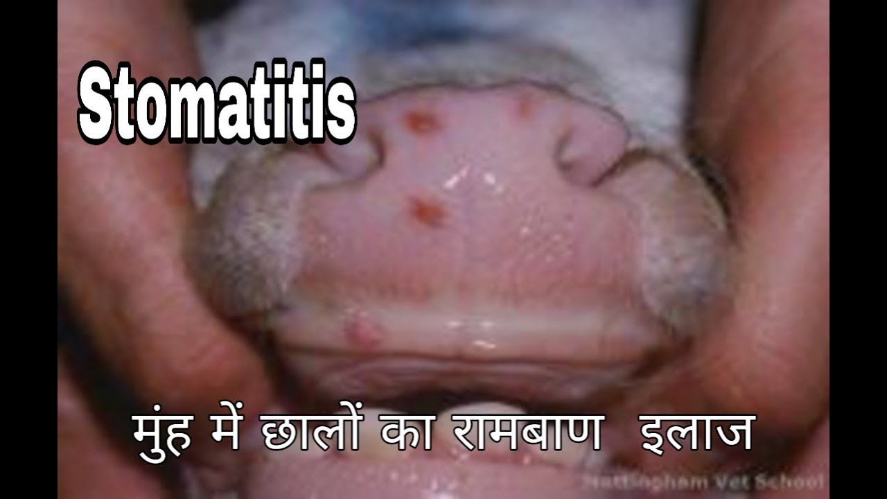 मुंह के छालो का रामबाण इलाज। Stomatitis treatment
