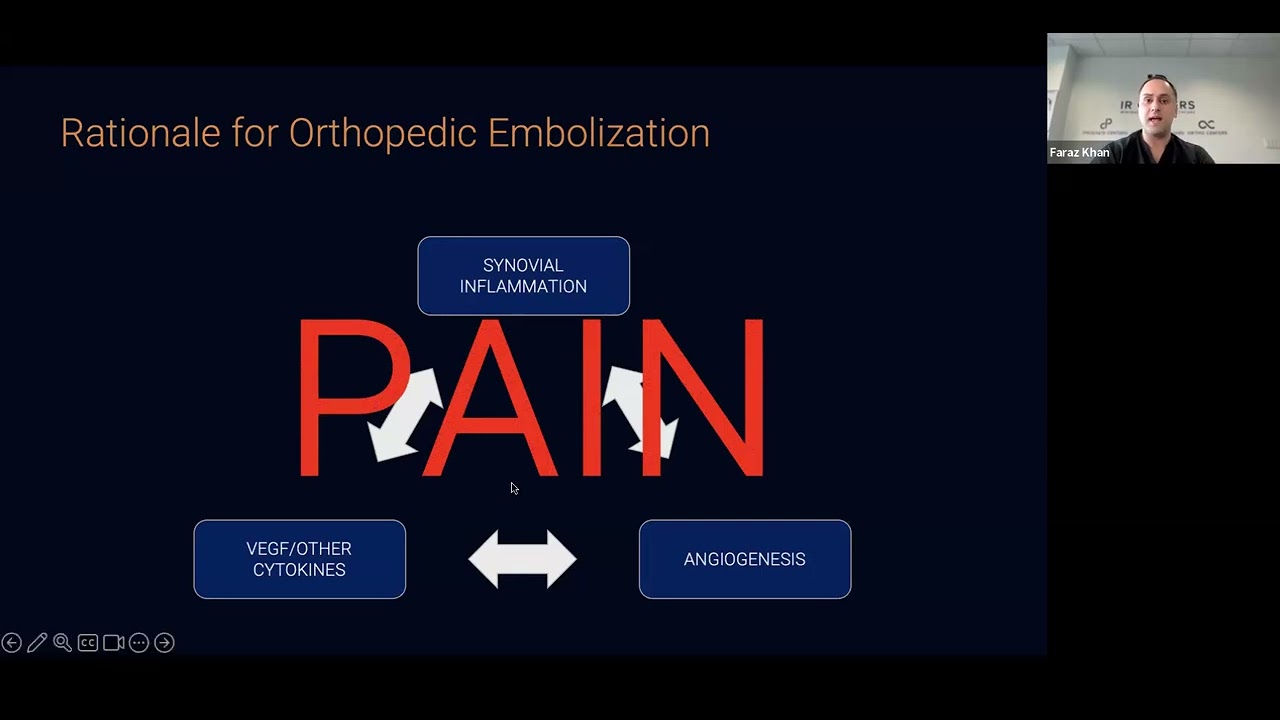 Say Goodbye to Knee Pain: Learn About Geniculate Artery Embolization (GAE)