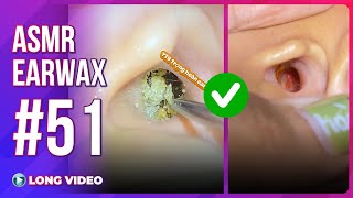 EP 51 Satisfying Deep Ear Wax Removal & Cleaning (No Talking ASMR)