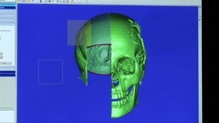 Doctors describe how they will repair Malala's skull