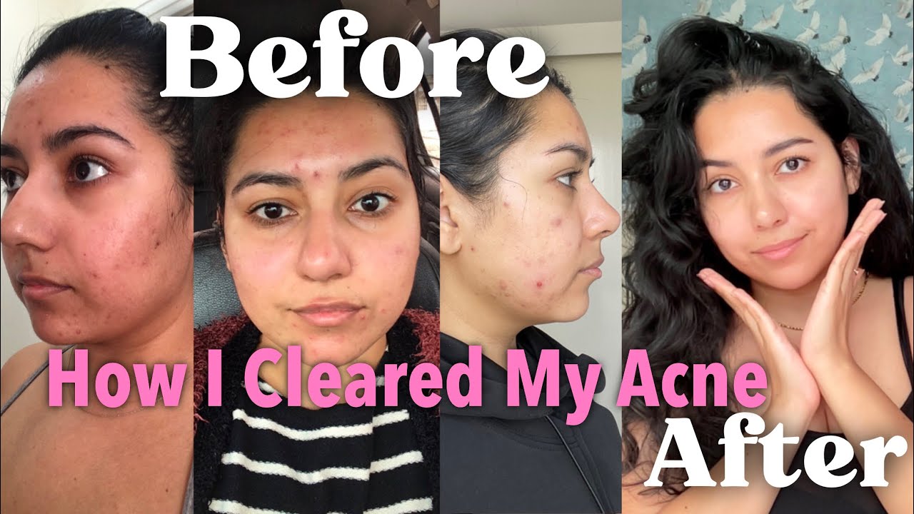 How I Cleared My Acne | Might Help You Too - YouTube