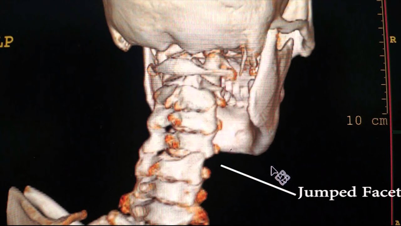 Unilateral C4 5 Jumped Facet With Quadriplegia YouTube