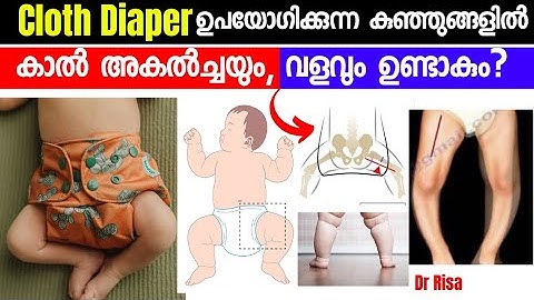 Diaper ഉപയോഗിക്കുന്നെ കുഞ്ഞിനെ കാൽ വളവ്, അകൽച്ചക്ക് കാരണം?|Cloth Diapers & Baby Walking| Bow Leg