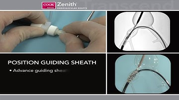 Iliac Branched device (IBD)