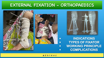 External fixation in orthopaedics - Indication | Types | Working principle | Complications