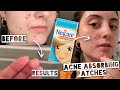 TESTING NEXCARE ACNE ABSORBING PATCHES FOR MY ACNE | Hydrocolloid Patches Results