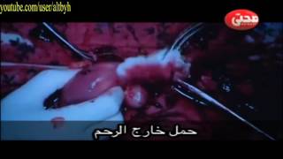 عملية استئصال من حمل خارج الرحم بالجراحة فى قناة فالوب salpingectomy for ectopic pregnancy