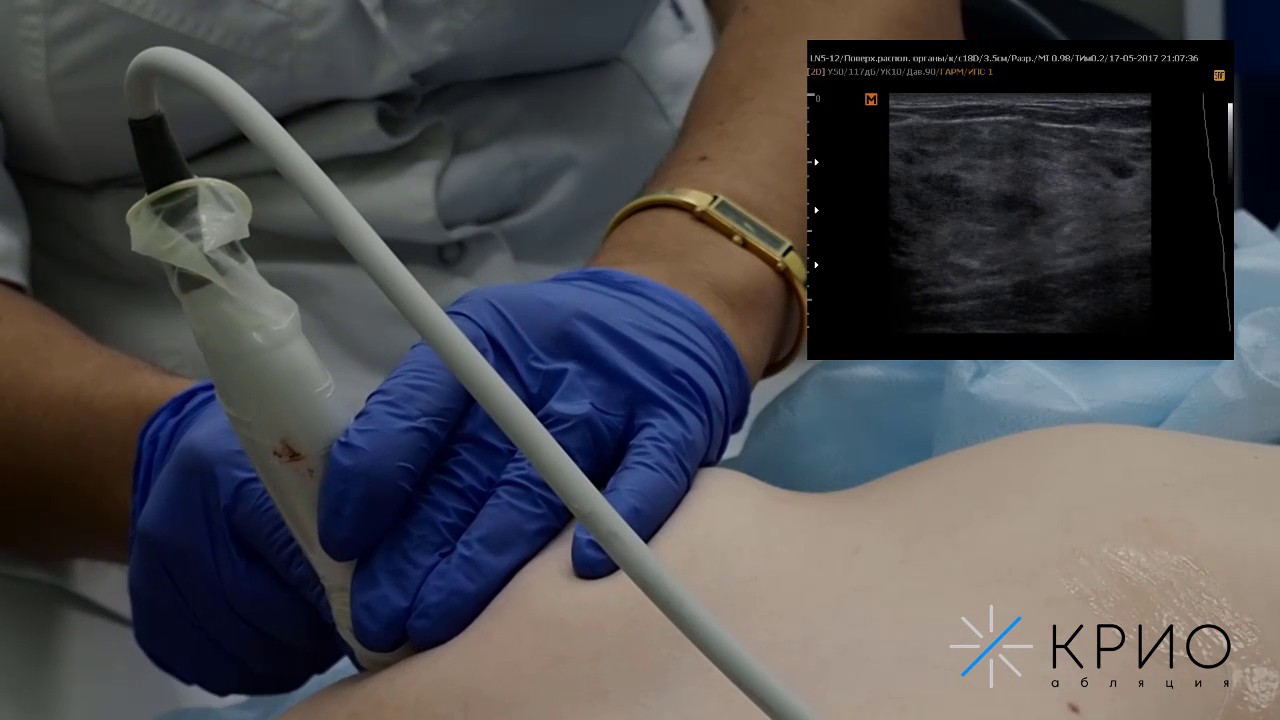 Криоабляция фиброаденомы. Лечение фиброаденомы. Удаление фиброаденомы ...