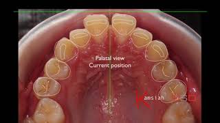 Digital Smile Design In Orthodontics
