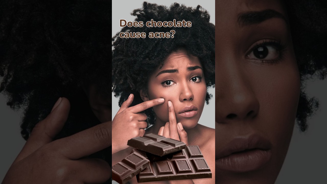 Does chocolate cause acne