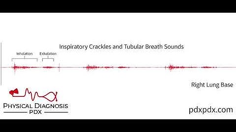 The Lung Sounds of Pneumonia