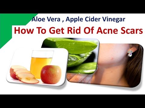 how-to-get-rid-of-acne-scars---aloe-vera,-apple-cider-vinegar