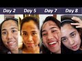 Mira's chemical peel recovery day-by-day