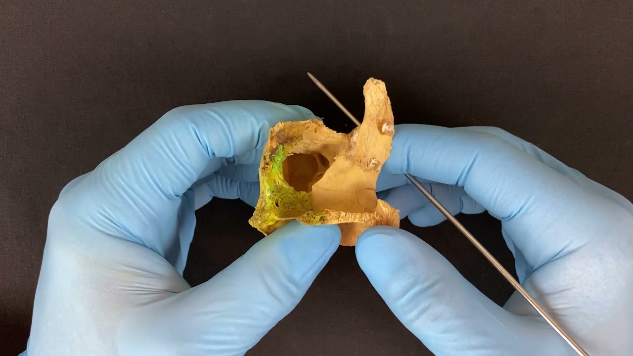 Верхняя челюсть - Maxilla (анатомия человека)