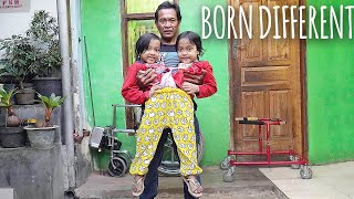 We're Conjoined Twins Who Share Legs | BORN DIFFERENT
