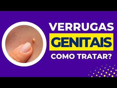 Como tratar verrugas genitais?