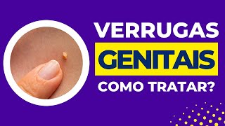 Como Tratar Verrugas Genitais?