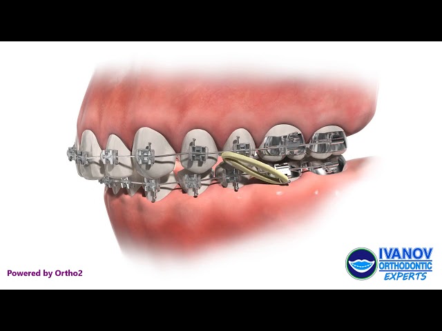 How Do You Fix an Overbite? - Burke & Beckstrom Orthodontics