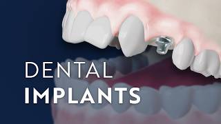 Dental Implants: Restore Function and Preserve Health