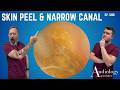 Skin Peel Hiding the Wax, a Canal Too Narrow for Tools & Why We Use Oil – EP1288