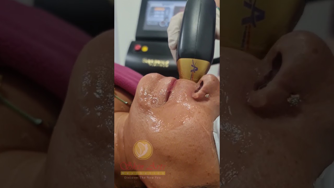 Laser Hair Removal at 