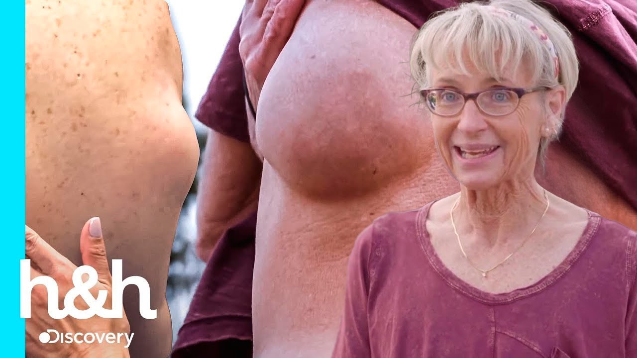 Pacientes con bultos de mayor antigüedad | Dra. Sandra Lee: Especialista en piel | Discovery H&H