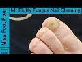 Fungal Nail Treatment Magical #2 Transformation by Miss Foot Fixer Marion Yau