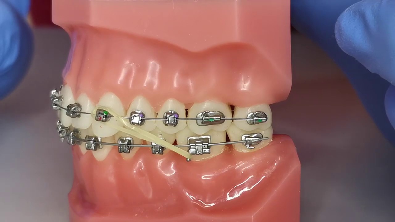 Crimpable Hook in Orthodontics 
