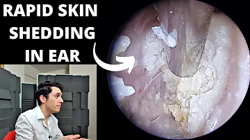 Rapid Skin Shedding Ear Clearance With Suction (Autoimmune Or Infection?)