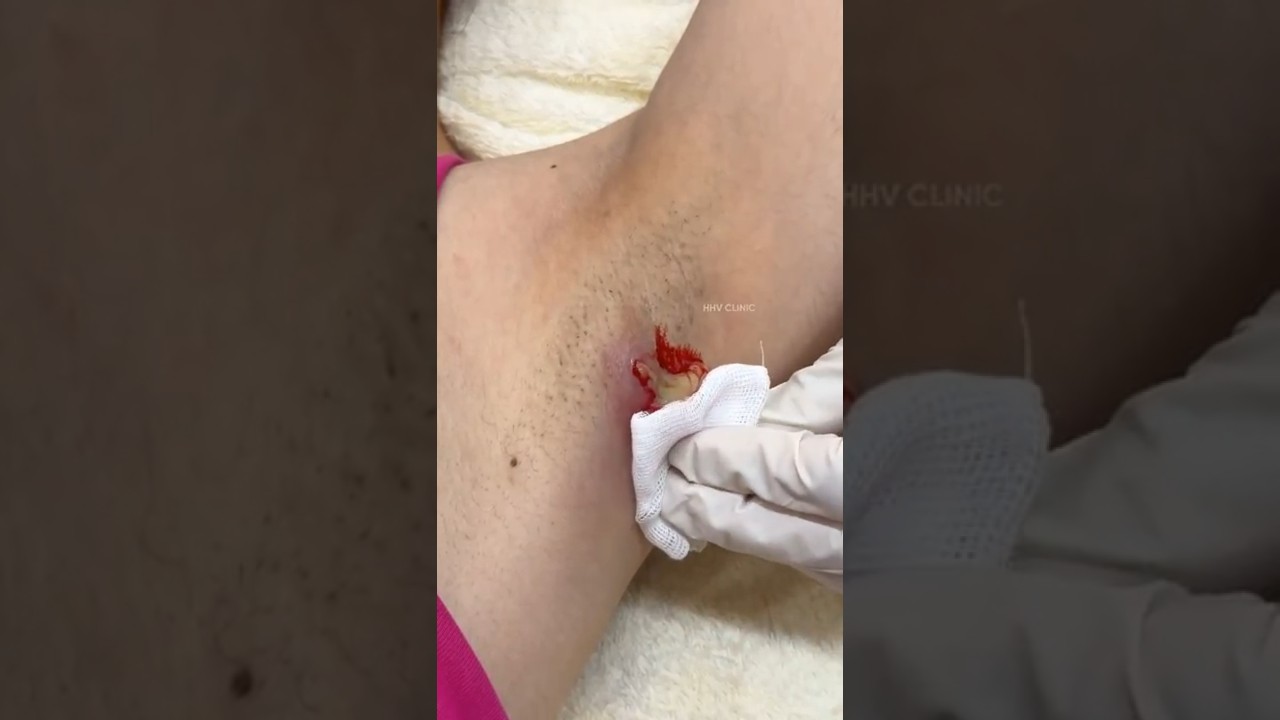 Nặn mụn áp xe sưng viêm to ở nách, nhiều dịch mủ.