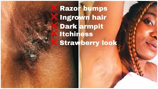 Nair Review-How I Use Nair Hair Removal To Get Rid Of  Ingrown Hairs And Razor Bumps.