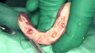 Case video: FullArch restoration on an edentulous mandible using four Straumann® Mini Implants