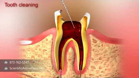 Elite Dental Care Tracy - Root Canal Treatment