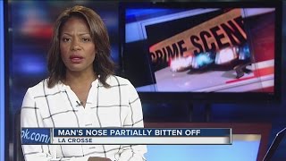 Mans Nose Partially Bitten Off During Bar Fight