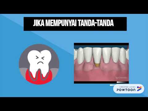 Video: Periodontitis - Rawatan Periodontitis Dengan Ubat-ubatan Rakyat Dan Kaedah