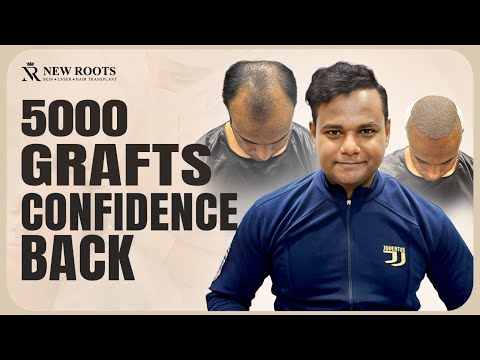 From Hair Loss to Hair Boss 😮 | Hair Transplant in Lucknow | Best Results | New Roots