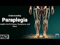 Paraplegia Unveiled: Exploring the Root Causes Behind Paralysis