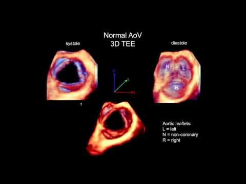 3D Echocardiography Acquisition, Cropping, and Case Examples
