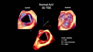 3D Echocardiography Acquisition, Cropping, and Case Examples