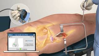 Intellijoint HIP Anterior by Intellijoint Surgical Inc