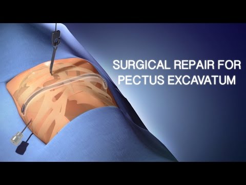 Pectus Excavatum Surgical Repair | A Cincinnati Children&rsquo;s Medical Animation
