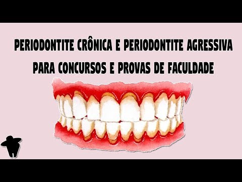 Vídeo: Periodontite Aguda E Crônica - Tratamento, Sintomas